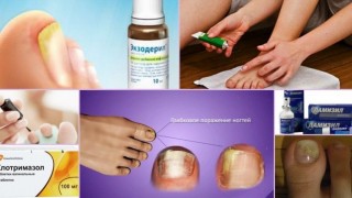 Best remedies for nail fungus