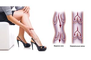 The best remedy for varicose veins