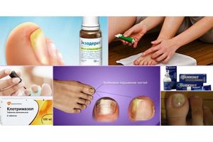 Best remedies for nail fungus